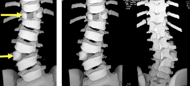 Common Scoliosis Questions 6