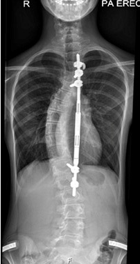 Common Scoliosis Questions 9